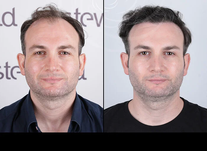 hair-before-after1.webp