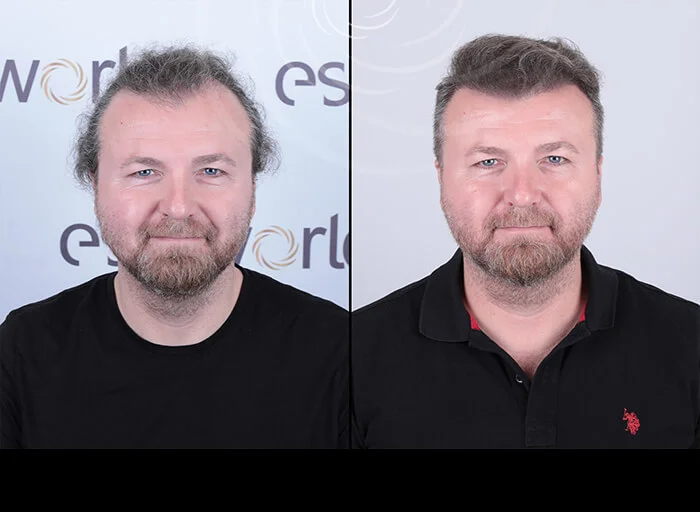hair-before-after10.webp