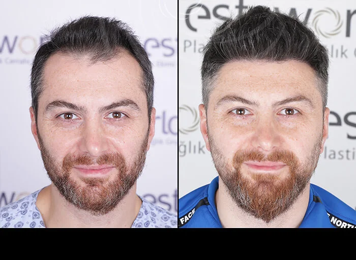 hair-before-after11.webp