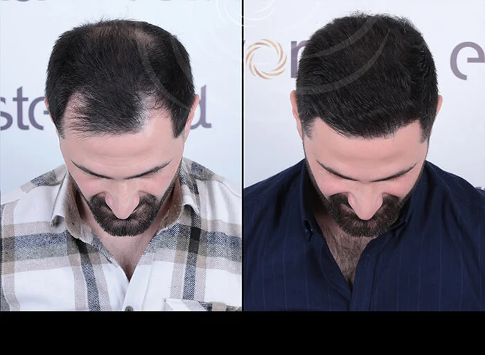 hair-before-after12.webp