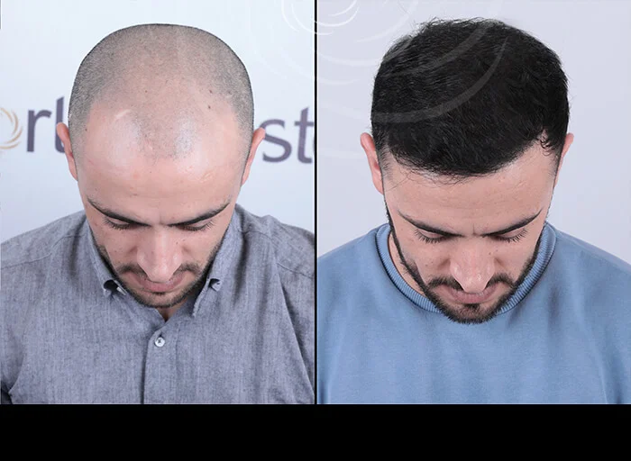 hair-before-after14.webp