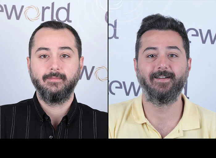 hair-before-after15.webp