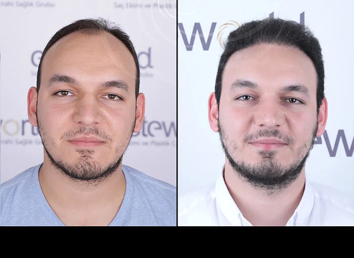 hair-before-after16.webp