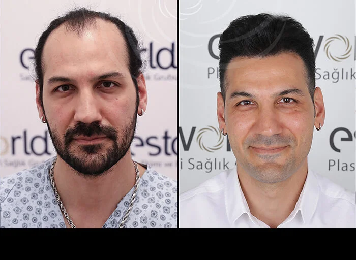 hair-before-after17.webp