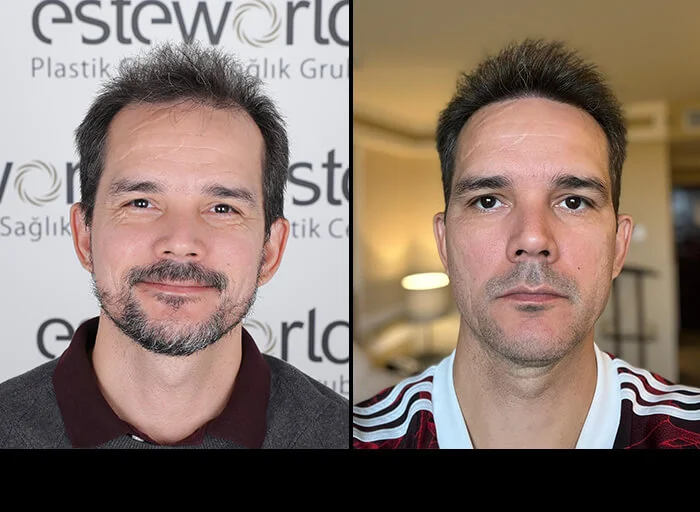 hair-before-after18.webp