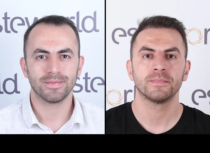 hair-before-after19.webp