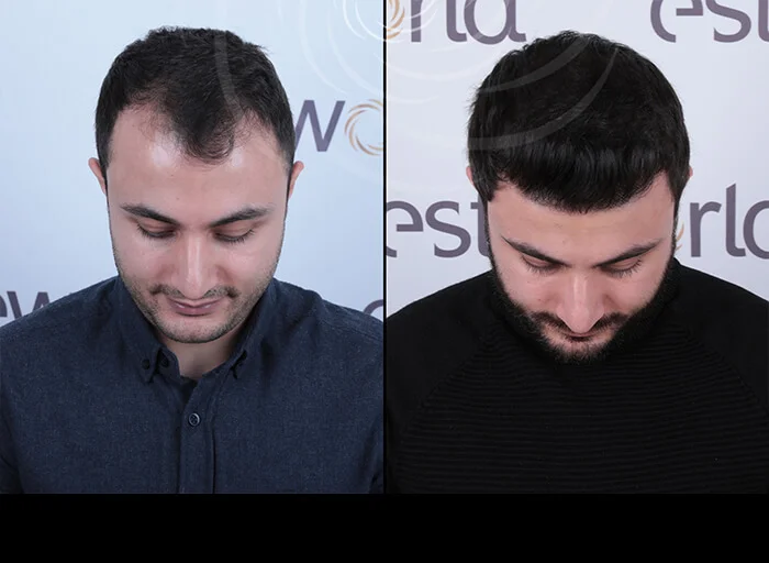 hair-before-after2.webp