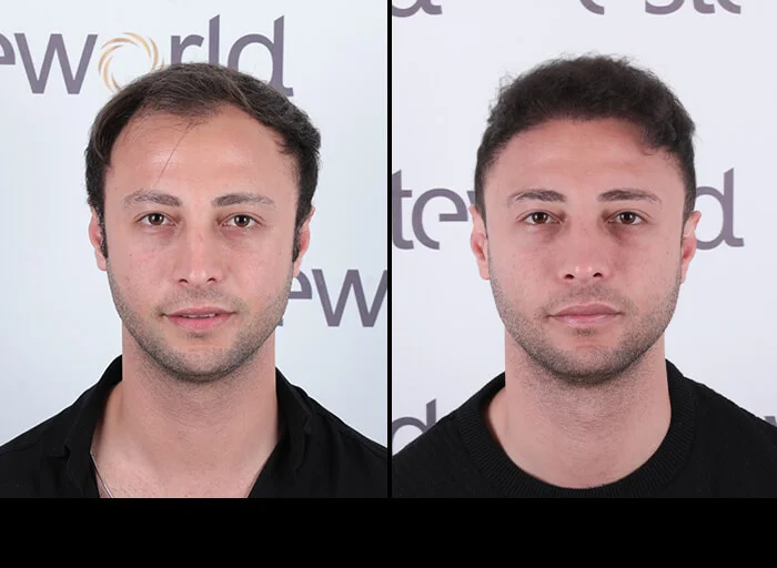 hair-before-after20.webp