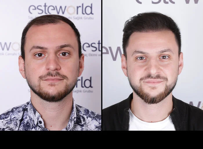 hair-before-after21.webp