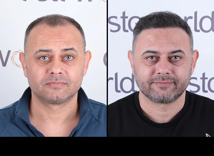 hair-before-after22.webp