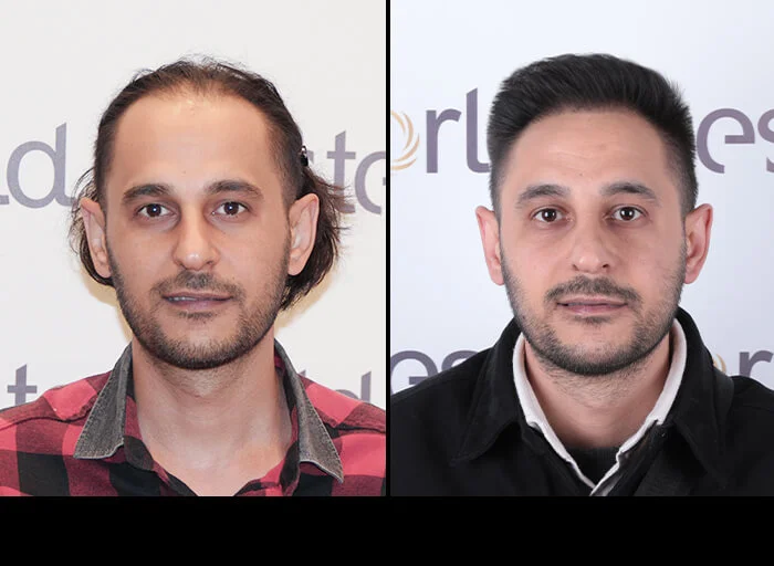hair-before-after23.webp