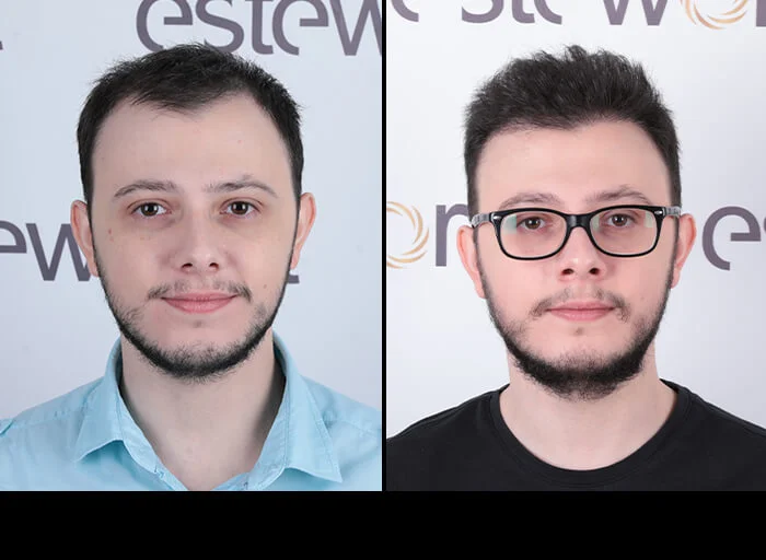 hair-before-after24.webp