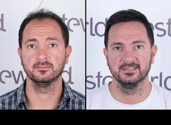 hair-before-after25.webp