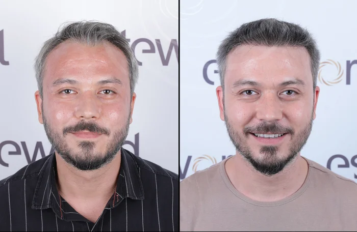 hair-before-after26.webp