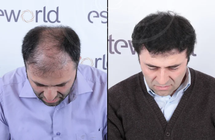 hair-before-after28.webp