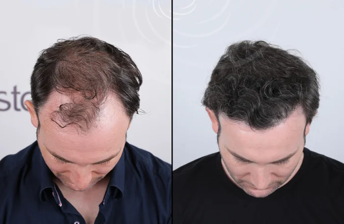 hair-before-after29.webp
