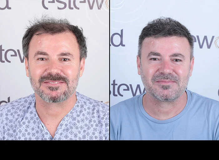 hair-before-after3.webp