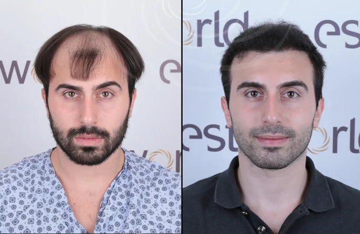 hair-before-after30.webp
