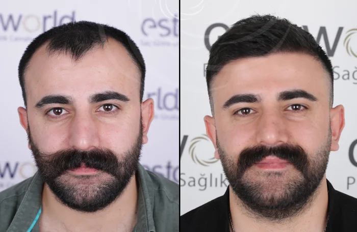 hair-before-after31.webp