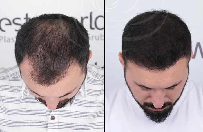 hair-before-after32.webp