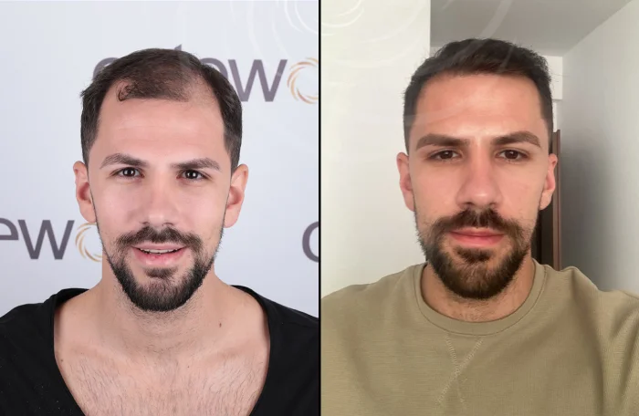 hair-before-after33.webp