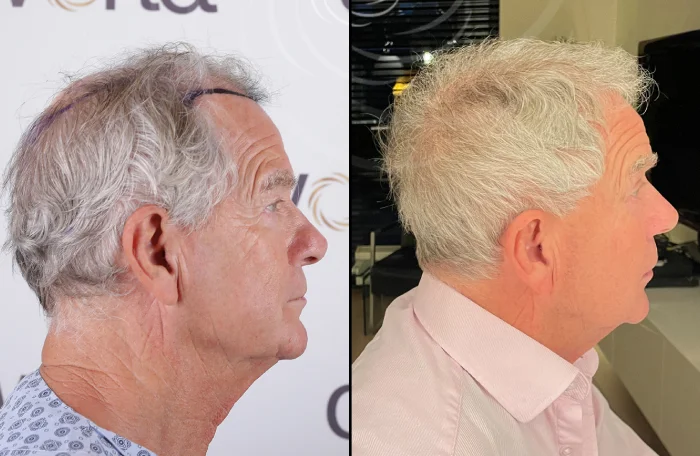 hair-before-after35.webp