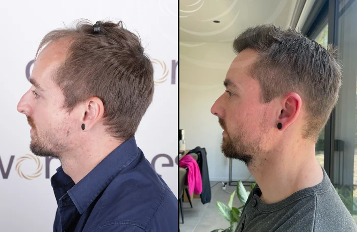 hair-before-after37.webp