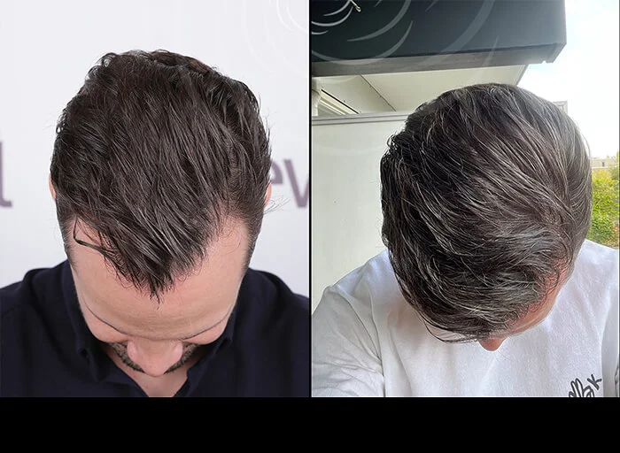 hair-before-after4.webp