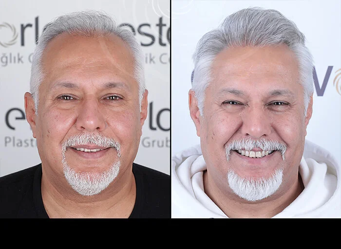 hair-before-after5.webp