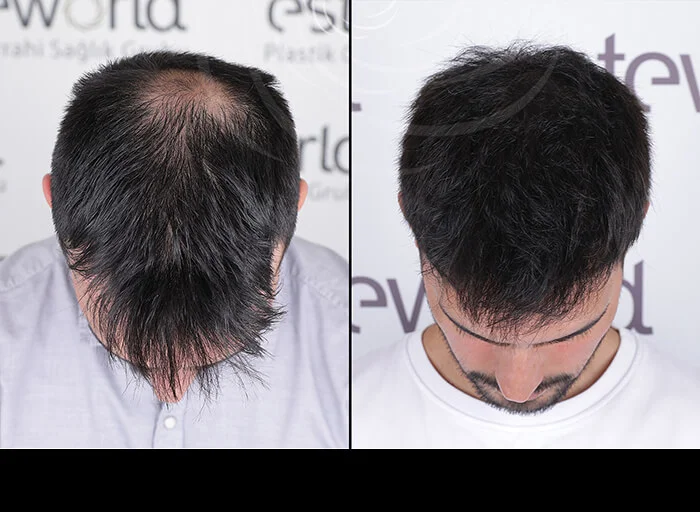 hair-before-after6.webp