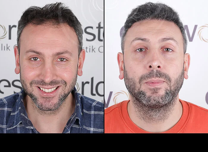 hair-before-after7.webp
