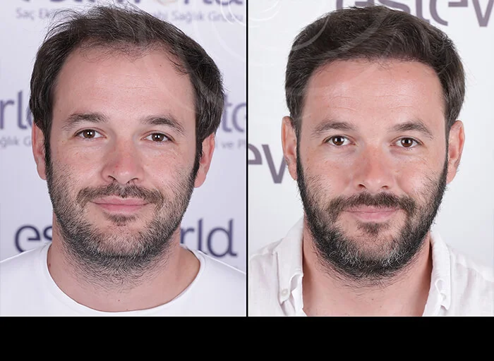 hair-before-after8.webp