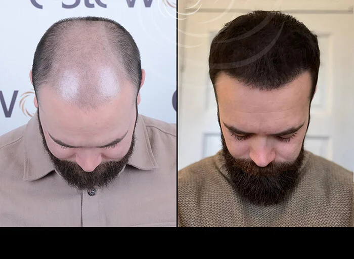 hair-before-after9.webp